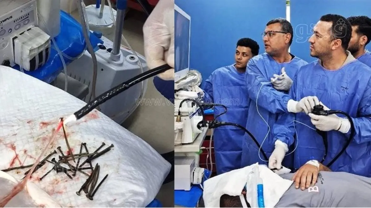 استخراج 100 مسمار من بطن مصري دون جراحة